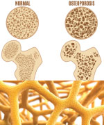 Normal bone density and osteoporosis